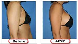 Breast Enlargement Before and After