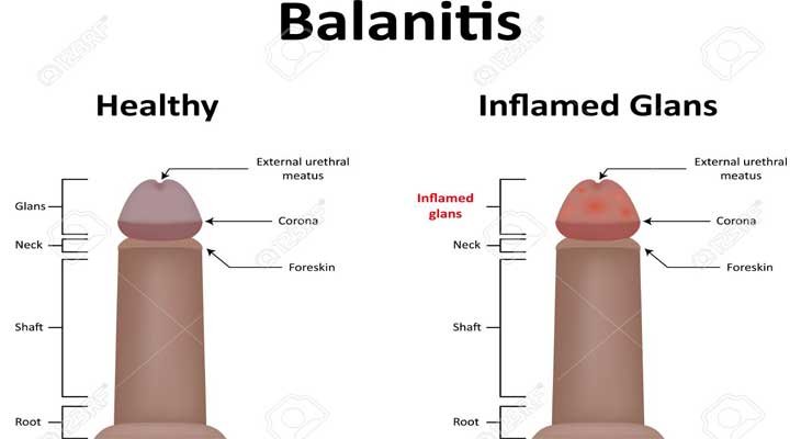 Balanitis Issue