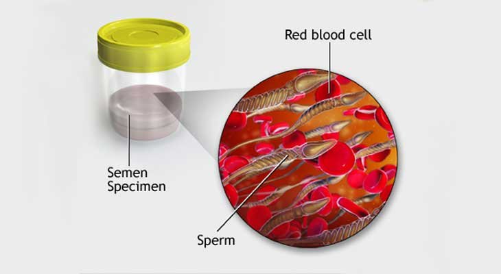 Blood in Semen Issue