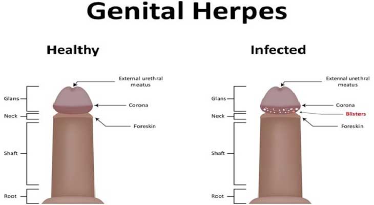 Genital Herpes Problem