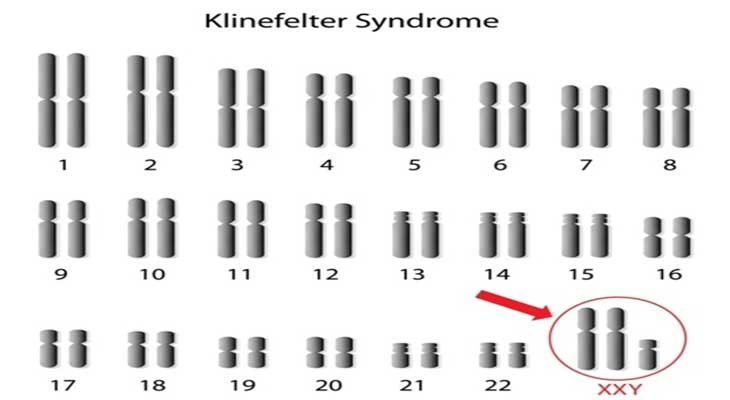 Klinefelter’s Syndromes