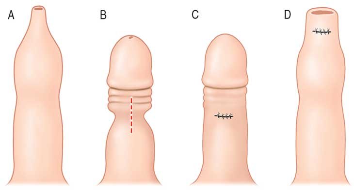 Penis Foreskin Problem