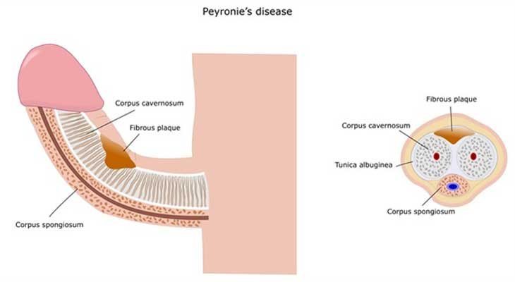 Peyronie's Disease