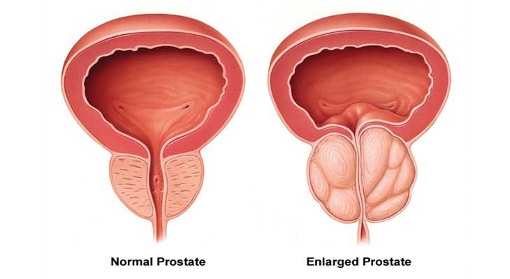 Prostate Enlargement Problem