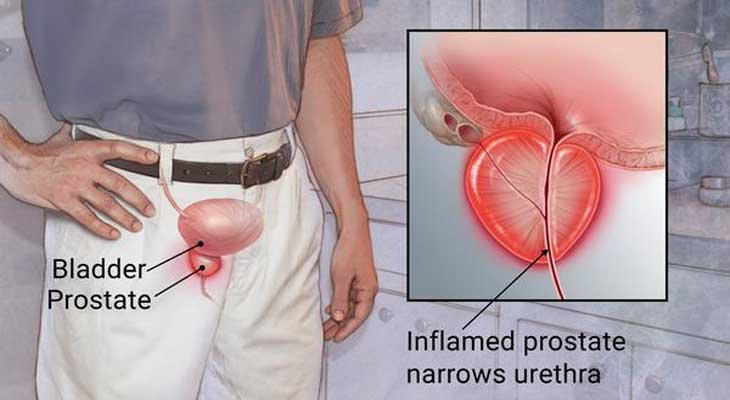 Prostatitis Problem