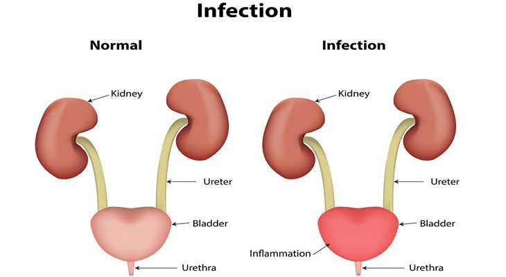 Urinary Tract Infections